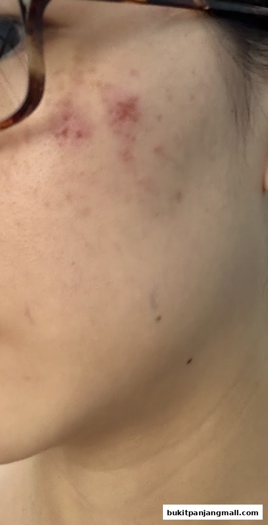 Close-up of a person's face showing skin blemishes and part of glasses.